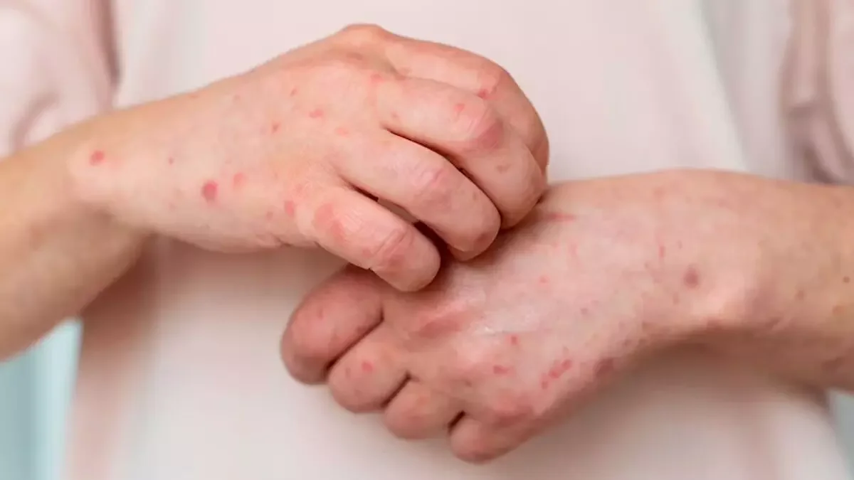 Survey shows older adults with chronic health conditions are hit hard by shingles - The Hindu - 4
