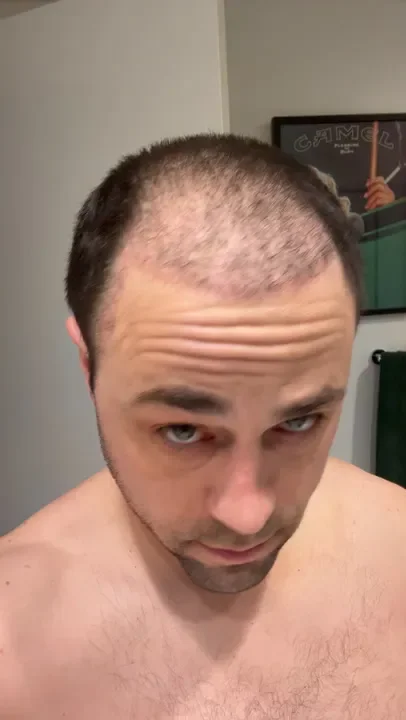 Triplets paid $13,000 each for hair transplants. It gave them new confidence in their jobs. - 3