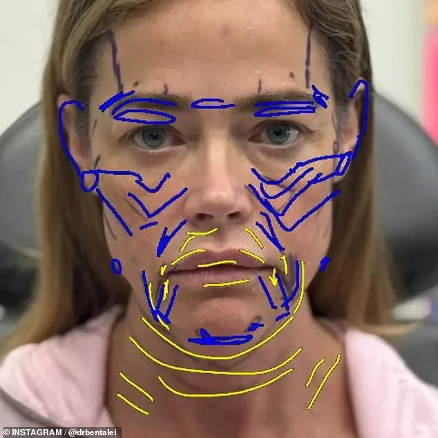 Denise Richards's plastic surgeon reveals stunning before-and-after photos of her facelift - 3