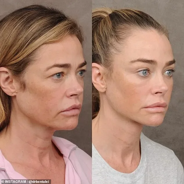 Denise Richards's plastic surgeon reveals stunning before-and-after photos of her facelift - 4