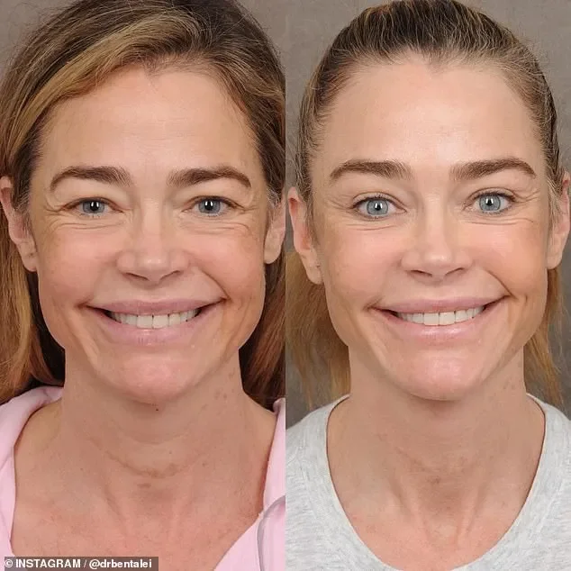 Denise Richards's plastic surgeon reveals stunning before-and-after photos of her facelift - 2