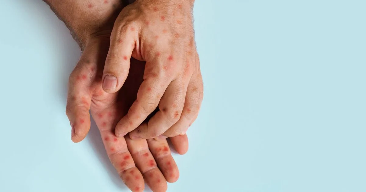 New recombinant mpox strain detected in UK and India, WHO urges continued monitoring - UN News - 1