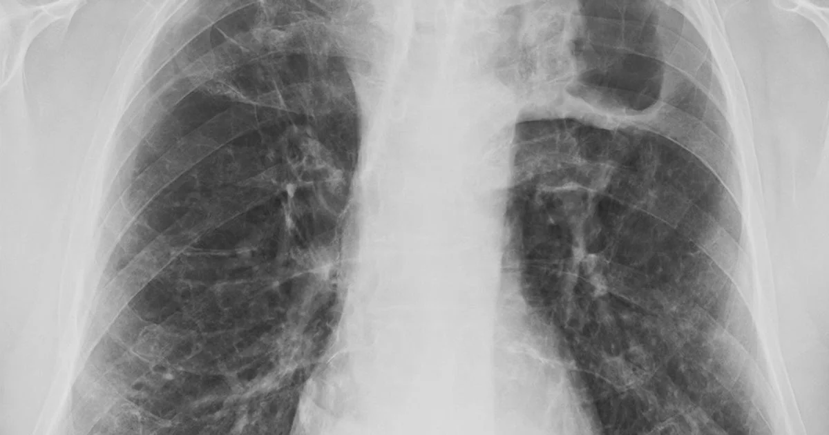 96 new cases of Victorian disease - when to 'contact GP urgently' - 2