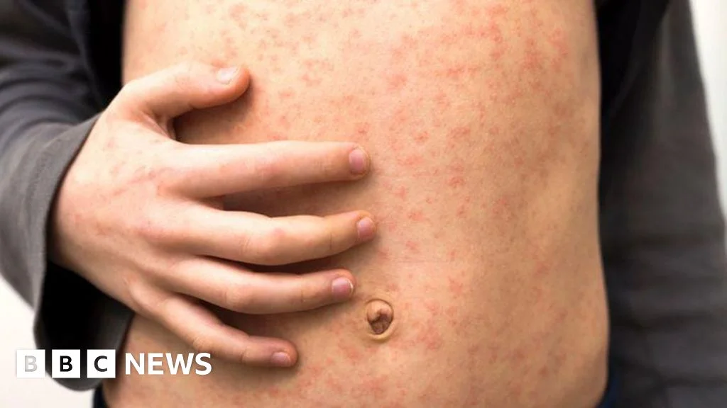 'Fast-spreading' measles outbreak hits several schools in London - 4