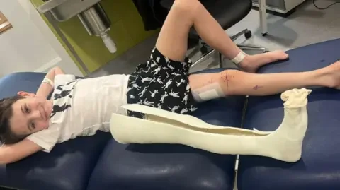 Boy first in UK to have pioneering leg-lengthening surgery - 2