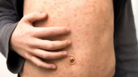'Fast-spreading' measles outbreak hits several schools in London - 1