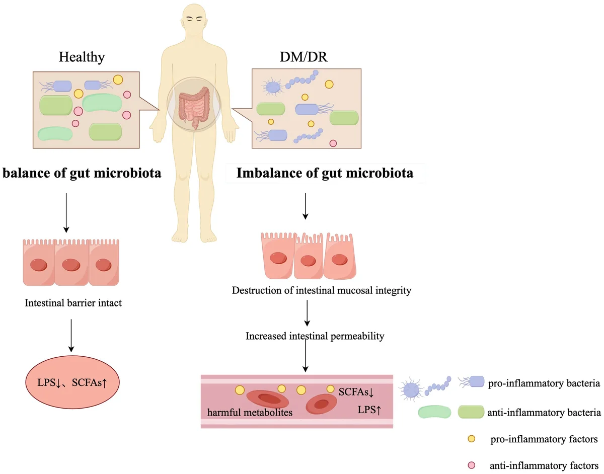 Gut Microbiota Dysbiosis is a Factor in Diabetic Retinopathy - European Medical Journal - 3