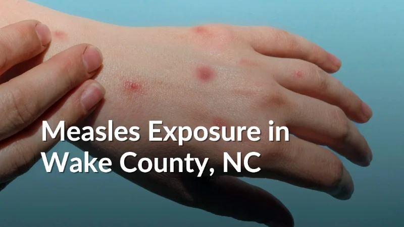 Wake County Measles Outbreak: First Signs, Risk Factors, Places to Avoid as Authorities Flag Several Areas - 2