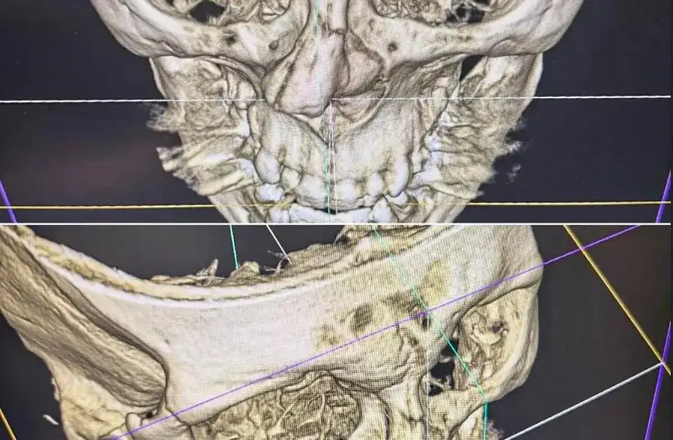 Dvalishvili refuses surgery despite nose breaks - 1