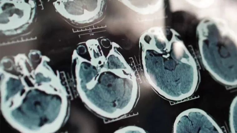 Common condition affecting up to HALF of older Americans raises dementia risk, study finds - 1