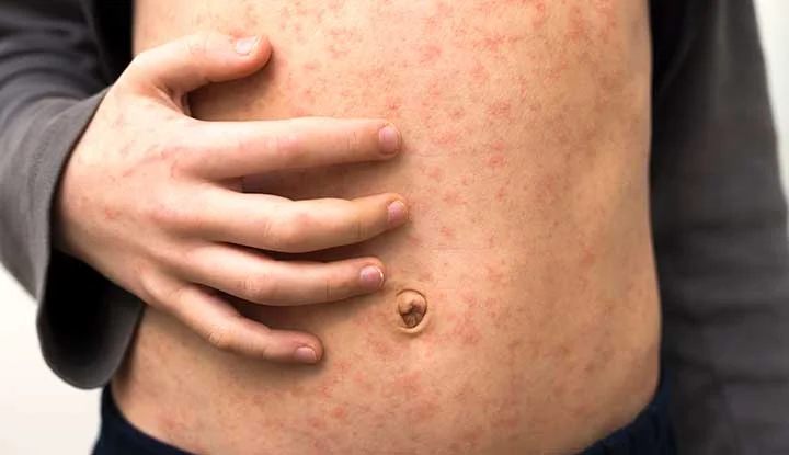 What is measles and how does it spread? - 4