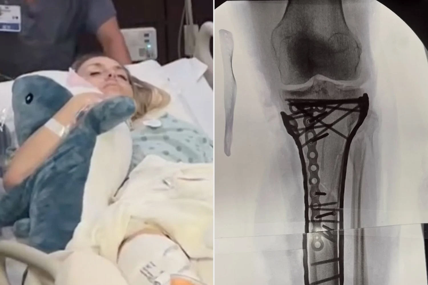 Lindsey Vonn taking 'baby steps' after latest surgery that took over 6 hours: 'A lot of plates and screws' - 1