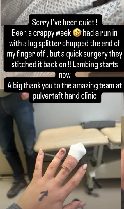 Clarkson's Farm star Harriet Cowan has finger stitched back on after horrific log splitter accident - 4