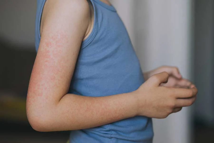 What is measles and how does it spread? - 1